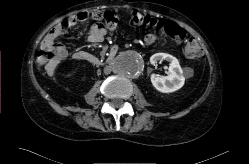 Abdominal aortic interposition tube graft and aneurysm thrombosis (Radiopaedia 71438-81857 Axial C+ arterial phase 83).jpg