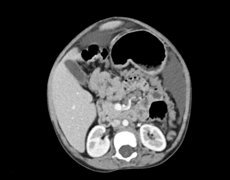 File:Abdominal premesenteric cystic lymphangioma (Radiopaedia 82995-97350 Axial C+ portal venous phase 25).jpg
