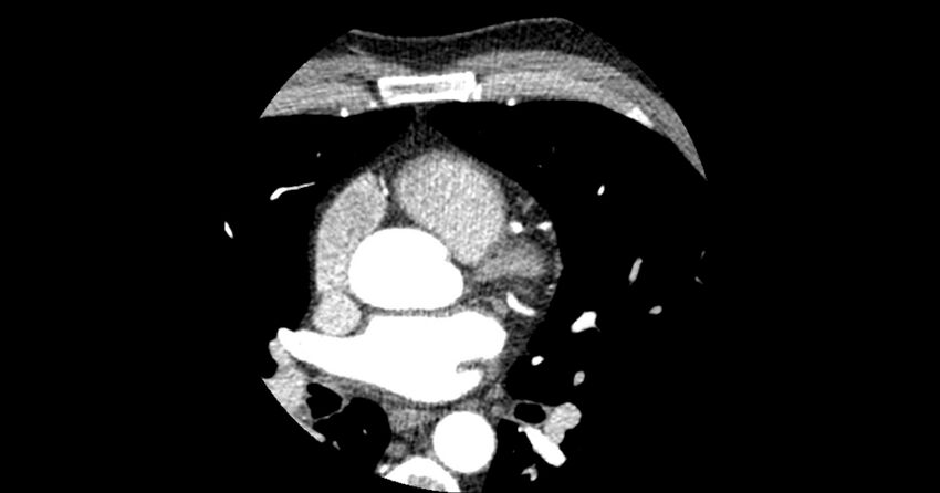 Aberrant left main coronary artery (ALMCA) arising from the right sinus with interarterial course (Radiopaedia 63251-71814 Axial C+ arterial phase 59).JPG