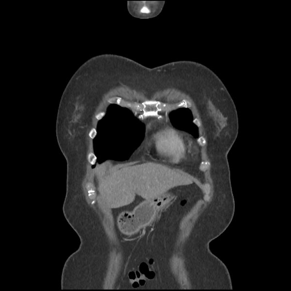 File:Aberrant right subclavian and left vertebral arteries (Radiopaedia 43467-46847 Coronal C+ portal venous phase 11).jpg