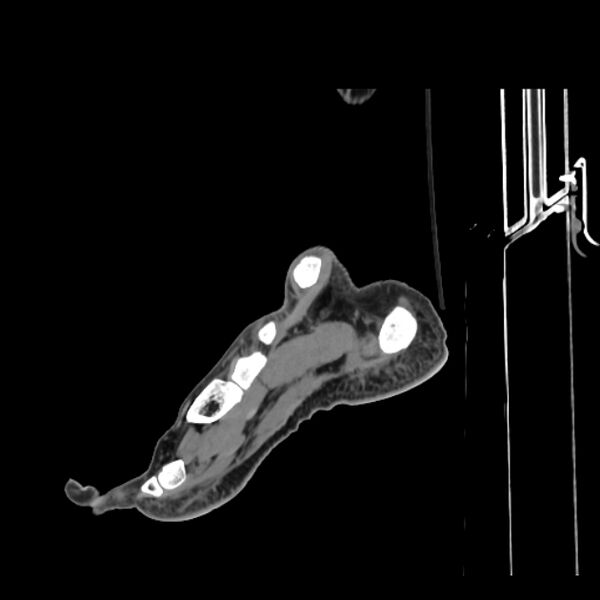 File:Accessory soleus muscle (Radiopaedia 61069-68943 Sagittal non-contrast 36).jpg