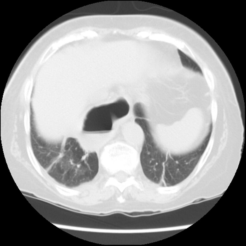 Achalasia (Radiopaedia 44094-47649 Axial lung window 47).jpg
