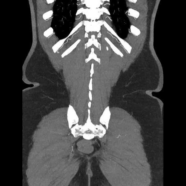 File:Active colonic bleed on CT (Radiopaedia 49765-55025 Coronal art MIP 53).jpg