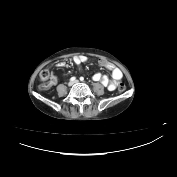 File:Acute-on-chronic Crohn disease with enteroenteric fistula (Radiopaedia 66686-75987 B 24).jpg