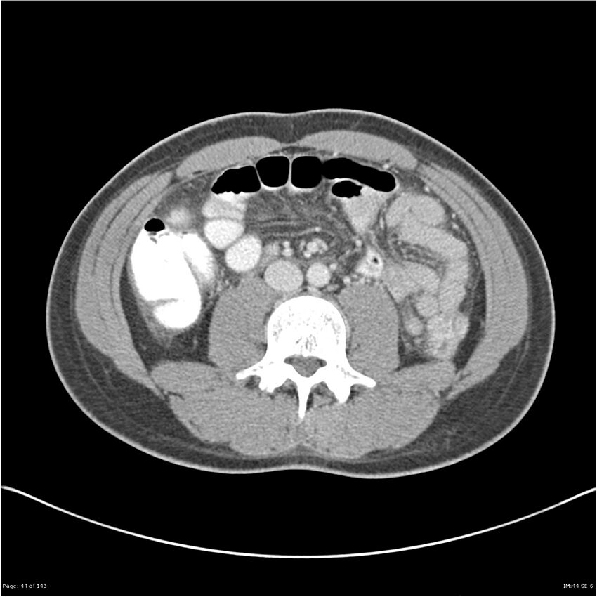 Acute appendicitis (Radiopaedia 25364-25615 B 34).jpg