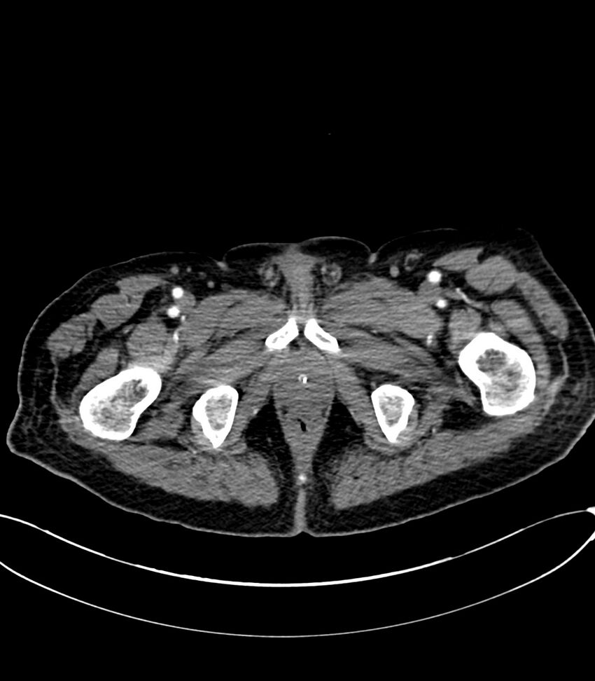 Acute arterial mesenteric ischemia (Radiopaedia 78238-90828 Axial C+ arterial phase 147).jpg