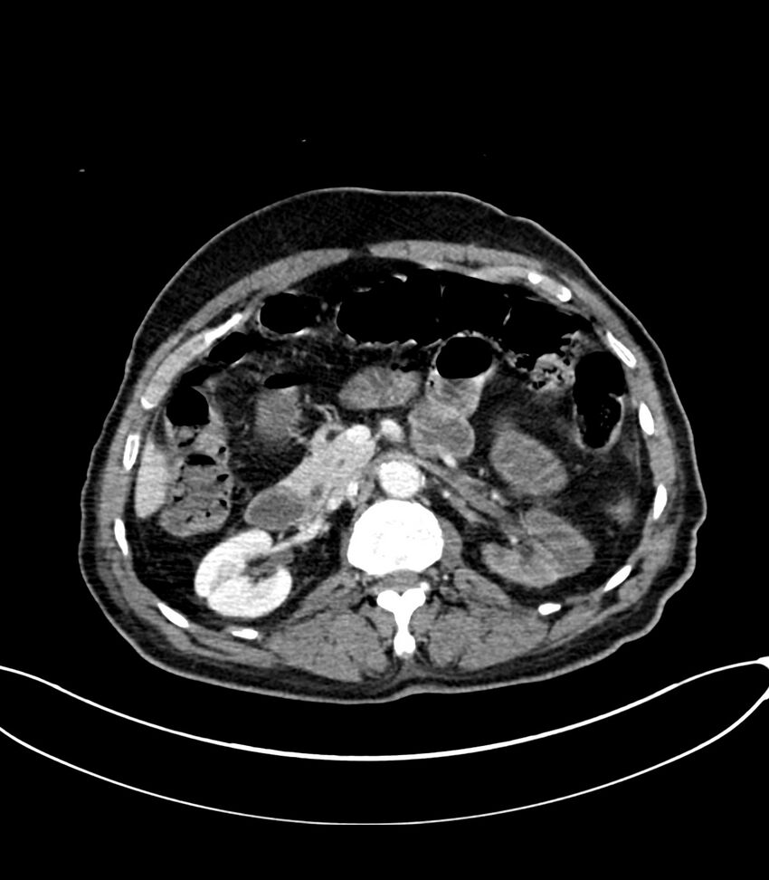 Acute arterial mesenteric ischemia (Radiopaedia 78238-90828 Axial C+ portal venous phase 53).jpg