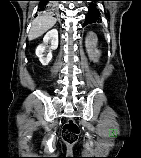 File:Acute arterial mesenteric ischemia (Radiopaedia 78238-90828 Coronal C+ portal venous phase 70).jpg