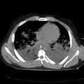 Acute aspiration pneumonitis (Radiopaedia 33605-34703 Axial non-contrast 51).jpg