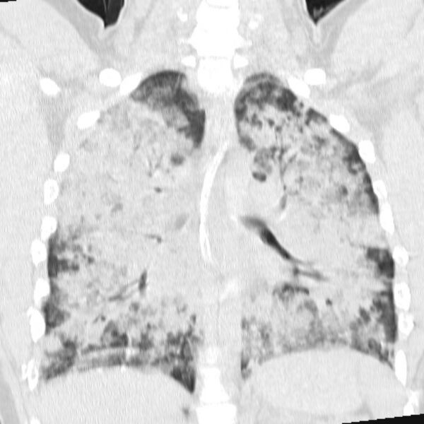 File:Acute aspiration pneumonitis (Radiopaedia 33605-34703 Coronal lung window 51).jpg