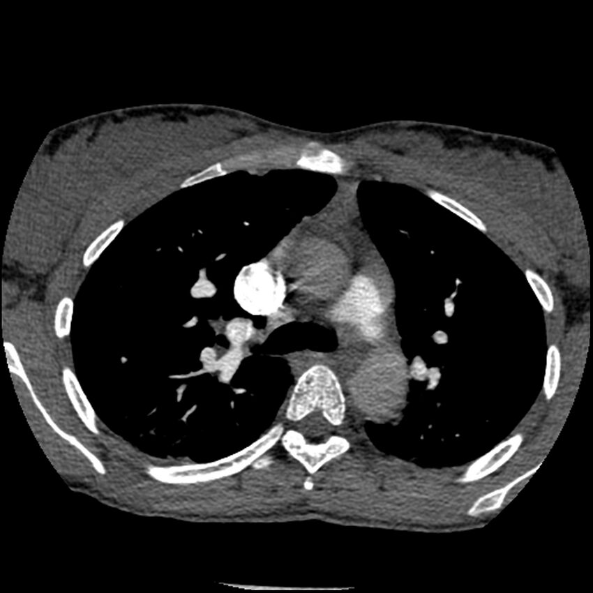 Acute chest syndrome - sickle cell disease (Radiopaedia 42375-45499 Axial C+ CTPA 66).jpg