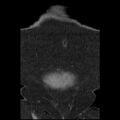 Acute cholecystitis and ureteric colic (Radiopaedia 42330-45444 Coronal prone 15).jpg