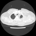 Acute heart failure (CT) (Radiopaedia 79835-93075 Axial lung window 5).png