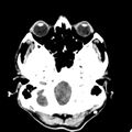 Acute hydrocephalus from VP shunt blockage (Radiopaedia 55488).jpg