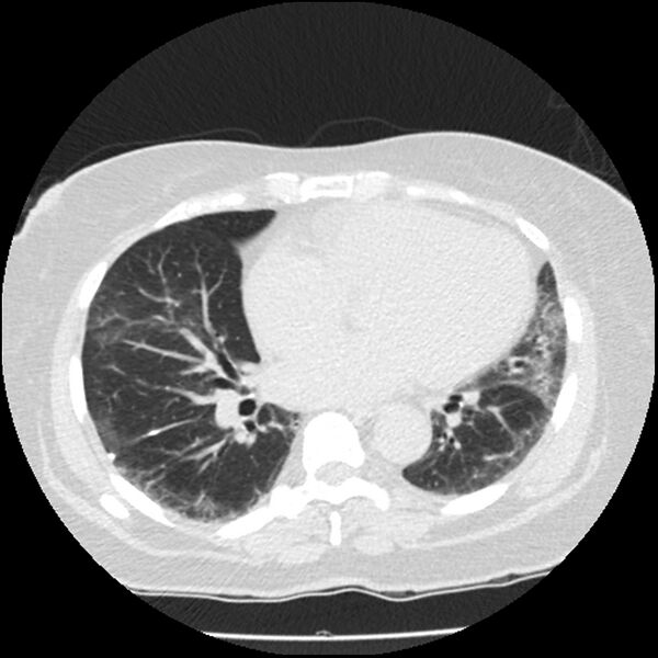 File:Acute interstitial pneumonitis (Radiopaedia 45404-49444 Axial lung window 65).jpg