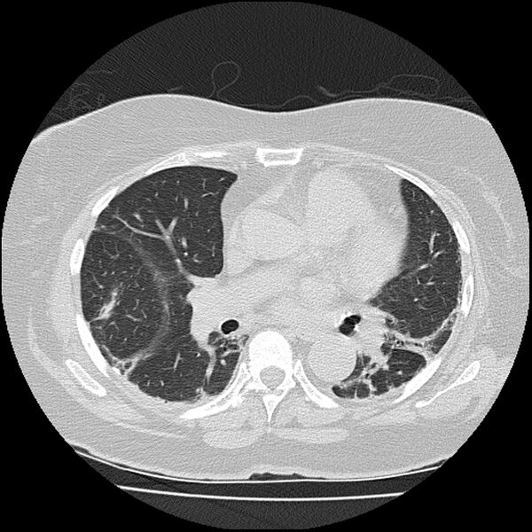 File:Acute interstitial pneumonitis (Radiopaedia 45404-49452 Axial lung window 49).jpg