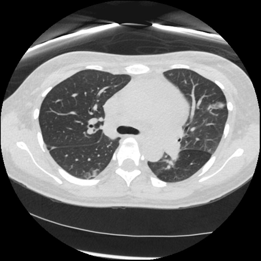 Acute lupus nephritis (Radiopaedia 45832-50107 Axial lung window 33).jpg