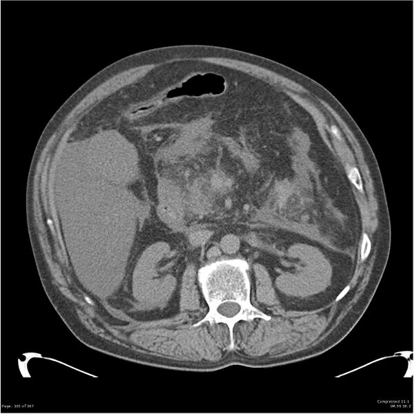 File:Acute pancreatitis (Radiopaedia 19135-19116 Axial non-contrast 19).jpg
