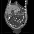 Acute pancreatitis (Radiopaedia 19135-19116 Coronal non-contrast 6).jpg