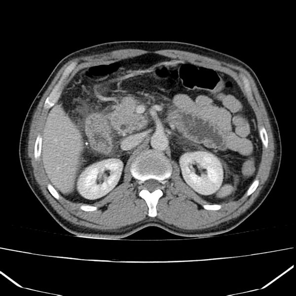 File:Acute pancreatitis (Radiopaedia 22572-22596 Axial C+ portal venous phase 26).jpg