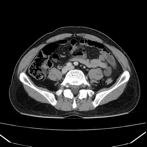 File:Acute pancreatitis (Radiopaedia 22572-22596 Axial C+ portal venous phase 49).jpg