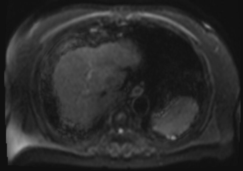 File:Acute portal vein thrombosis (Radiopaedia 73198-83925 Axial DWI 8).jpg