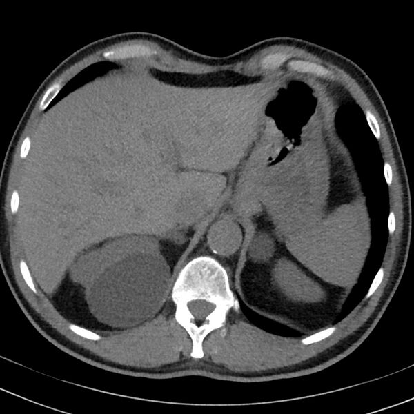 File:Acute pulmonary embolism (Radiopaedia 81677-95570 Axial non-contrast 18).jpg