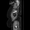 Acute pyelonephritis (Radiopaedia 25657-25837 Sagittal renal parenchymal phase 15).jpg