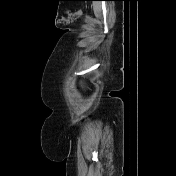 File:Acute pyelonephritis (Radiopaedia 25657-25837 Sagittal renal parenchymal phase 15).jpg