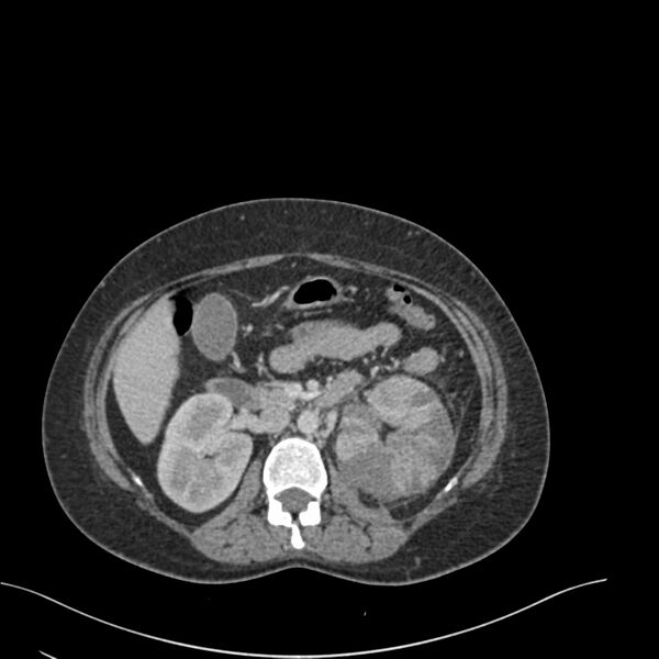 File:Acute pyelonephritis with renal vein thrombosis (Radiopaedia 58020-65053 Axial renal parenchymal phase 59).jpg
