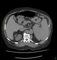 Acute renal failure post IV contrast injection- CT findings (Radiopaedia 47815-52557 Axial non-contrast 27).jpg