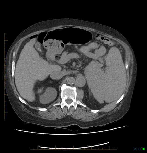 File:Acute renal failure post IV contrast injection- CT findings (Radiopaedia 47815-52557 Axial non-contrast 27).jpg