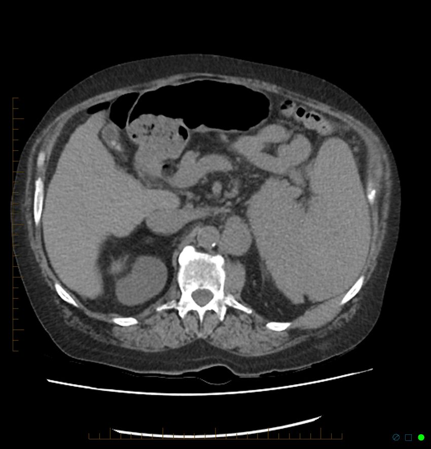 Acute renal failure post IV contrast injection- CT findings (Radiopaedia 47815-52557 Axial non-contrast 27).jpg