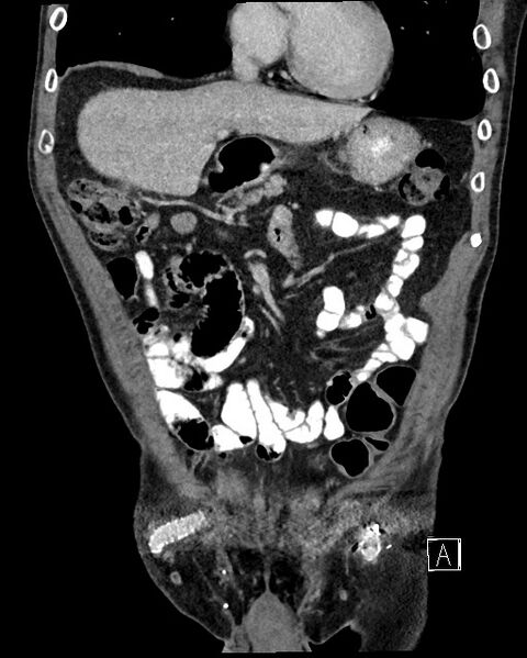 File:Acute renal infarction - rim capsular enhancement (Radiopaedia 59833-67270 Coronal C+ portal venous phase 7).jpg