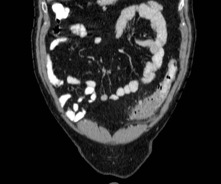 File:Acute sigmoid colon diverticulitis (Radiopaedia 55507-61976 Coronal C+ portal venous phase 20).jpg