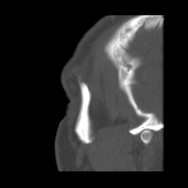 File:Acute sinusitis (Radiopaedia 23161-23215 Sagittal bone window 6).jpg