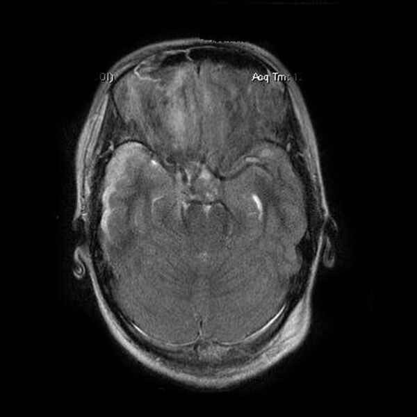 File:Acute subdural hemorrhage on MRI (Radiopaedia 5247).jpg