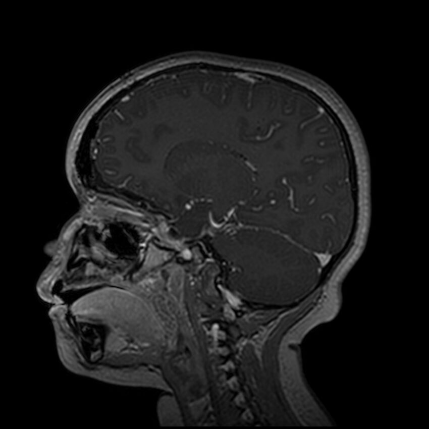 Adamantinomatous craniopharyngioma (Radiopaedia 77407-89529 H 73).jpg