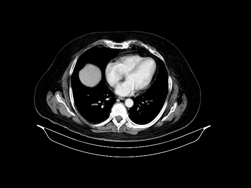 File:Adenocarcinoma of pancreas with hepatic metastasis (Radiopaedia 64332-73122 Axial C+ portal venous phase 10).jpg