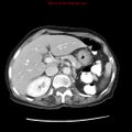 Adenocarcinoma of the colon (Radiopaedia 8191-9039 Axial liver window 22).jpg