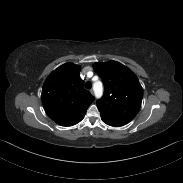 File:Adenocarcinoma of the lung (Radiopaedia 44205-47803 Axial C+ portal venous phase 23).jpg