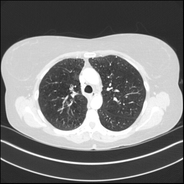 File:Adenocarcinoma of the lung (Radiopaedia 44205-47803 Axial lung window 34).jpg