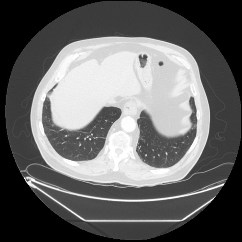 Adenocarcinoma of the lung (Radiopaedia 44876-48759 Axial lung window 67).jpg