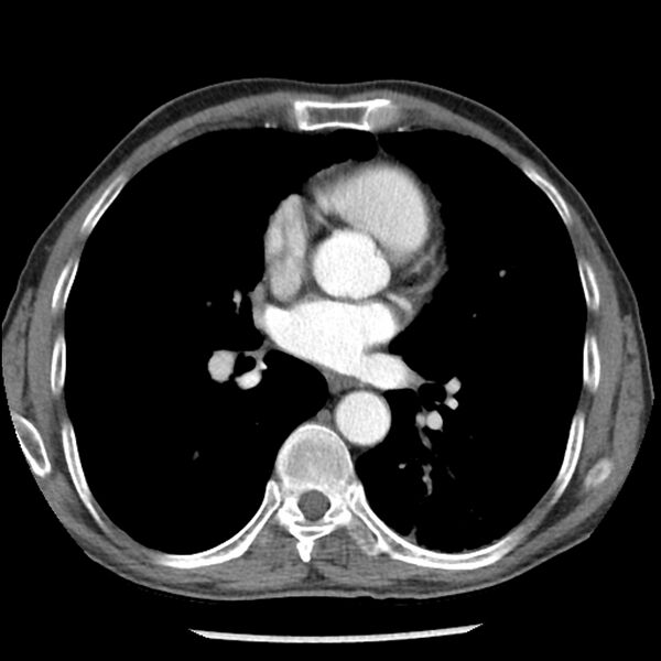 File:Adenocarcinoma of the lung - micropapillary predominant (Radiopaedia 42446-45563 Axial C+ portal venous phase 41).jpg