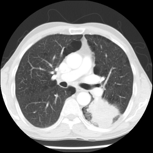File:Adenocarcinoma of the lung - micropapillary predominant (Radiopaedia 42446-45563 Axial lung window 33).jpg