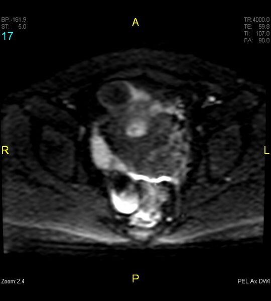 File:Adenomyosis (Radiopaedia 43504-46889 Axial DWI 17).jpg