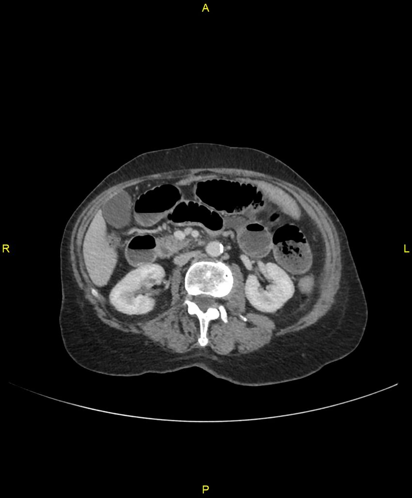 Adhesional small bowel obstruction (Radiopaedia 85402-101024 Axial C+ portal venous phase 120).jpg