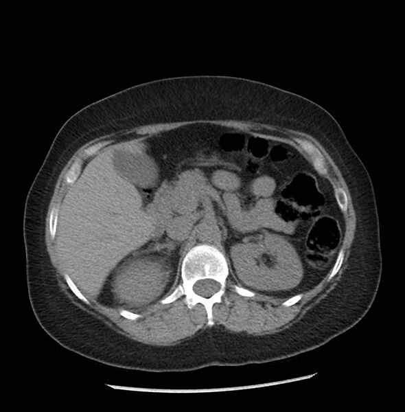 File:Adrenal cortical carcinoma with IVC invasion and thrombosis (Radiopaedia 34307-35597 Axial non-contrast 18).jpg