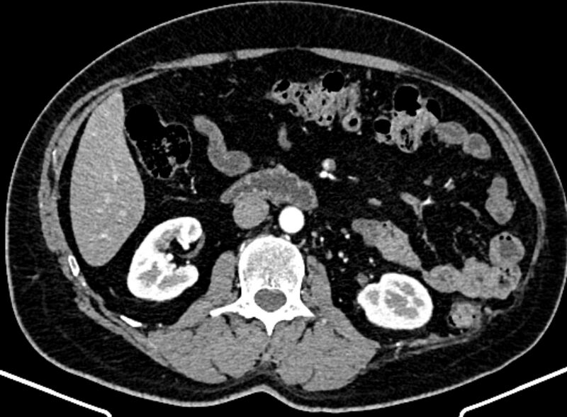 File:Adrenal metastases (Radiopaedia 73082-83791 Axial C+ arterial phase 82).jpg