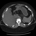 Adrenal myelolipoma (Radiopaedia 8216-9068 Axial non-contrast 7).jpg